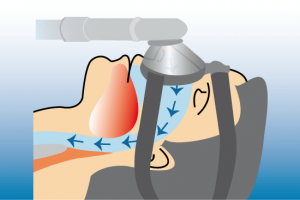 ´Durch die Beatmung mit Druckluft (CPAP) kann bei schwerer Schalfapnoe eine gleichmäßige Versorgung mit Sauerstoff sichergestellt werden. Solche Masken gibt es in den verschiedensten Ausführungen.