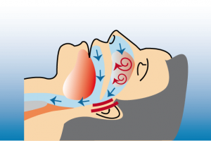 Bei anatomischen Veränderungen im Bereich der Nase oder des weichen Gaumens mit Zäpfchen kommt es zu Behinderungen und Verwirbelungen des Luftstroms - eine Ursache für Schnarchen.