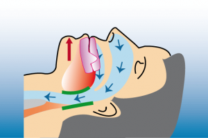 Mit einer Unterkiefer-Protrusionsschiene wird das Zurückfallen des Unterkiefers und der Zunge verhindert, so dass der Zungengrund den Luftweg wieder freigibt.